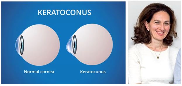 Keratoconus and Dr Rasha Al Taie